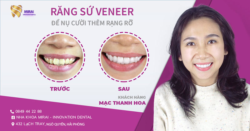  dán sứ veneer