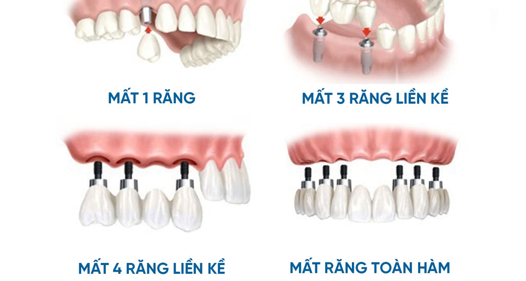 Trường hợp nên trồng răng implat