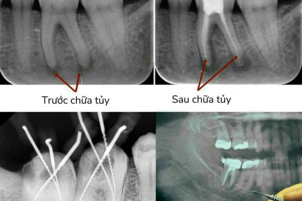   
          Răng sau khi chữa tủy sẽ tồn tại được trong bao lâu