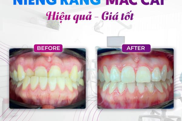   
          Chỉnh nha tại nha khoa MIRAI có gì khác biệt