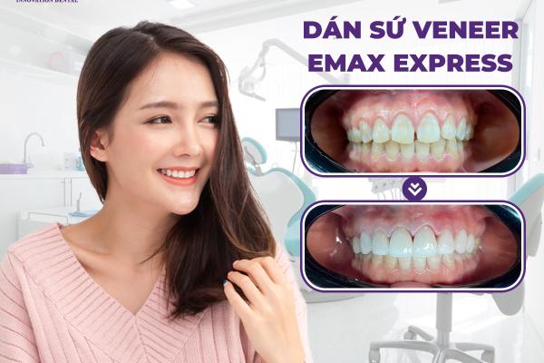   
          Nên chọn bọc răng sứ hay dán răng sứ cho răng?