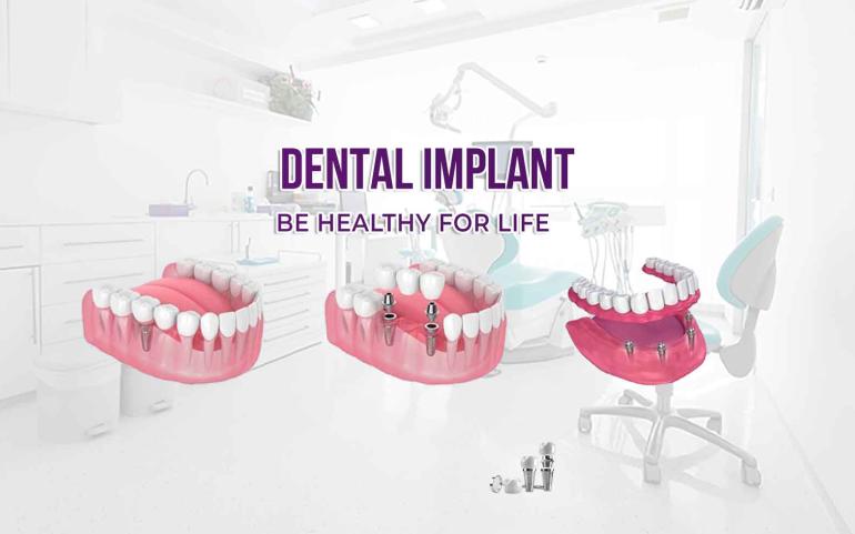 Dental implants