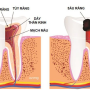   
          How to care for teeth after root canal and some notes