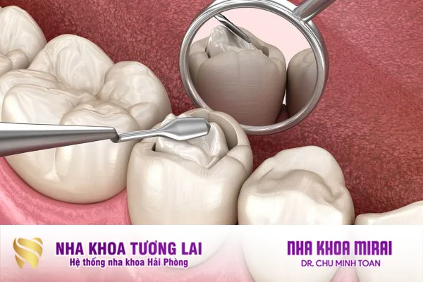 Hàn răng - Khắc phục răng sâu