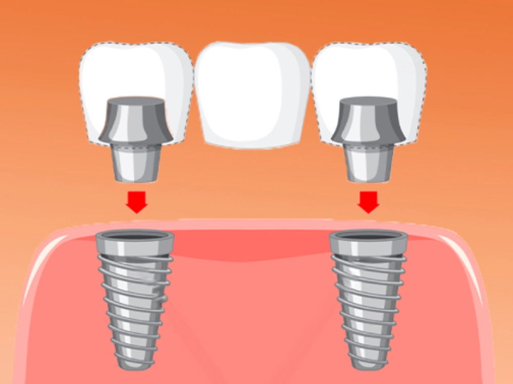 Cầu răng Implant, phù hợp với người mất nhiều răng