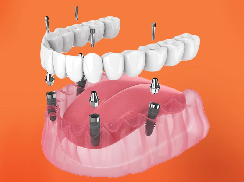 Implant all on 4 - 6 