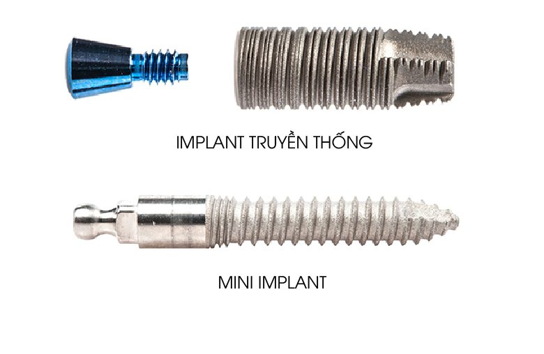 So sánh Implant truyền thống và Mini Implant 