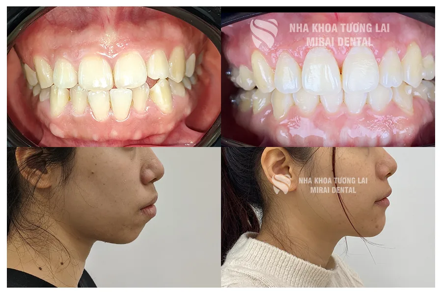 Niềng Invisalign - Thời gian 18 tháng