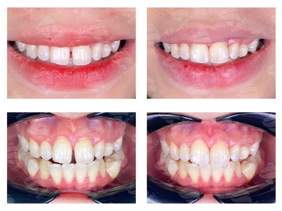 Hàn răng trong trường hợp răng bị thưa