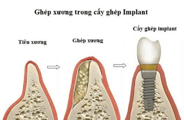 Ghép xương trong trồng Implant