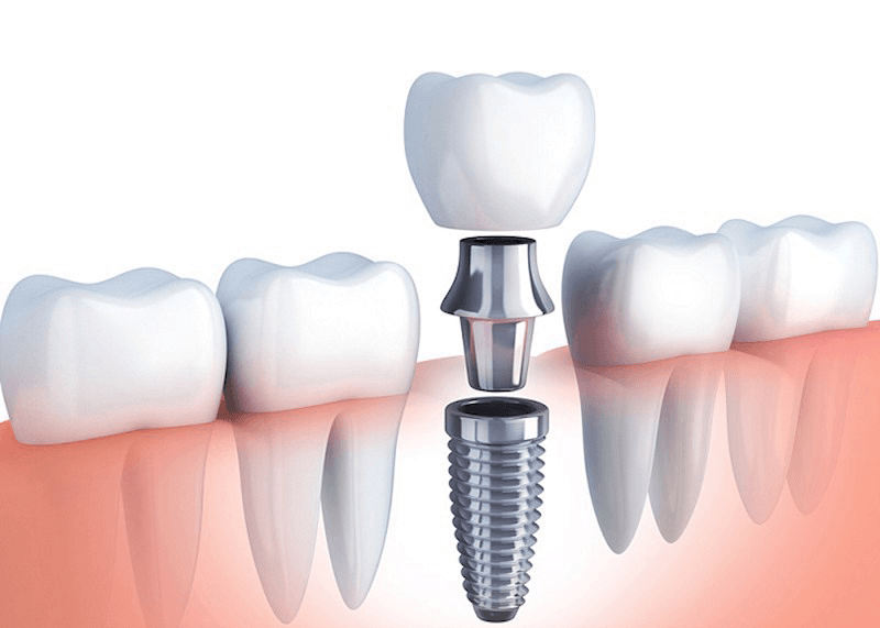 Cấu tạo của Implant trong cung hàm Cấu tạo của Implant trong cung hàm