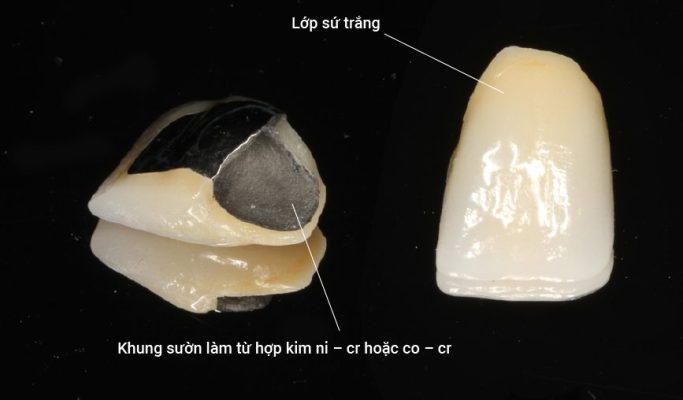 Cấu tạo răng sứ giá rẻ