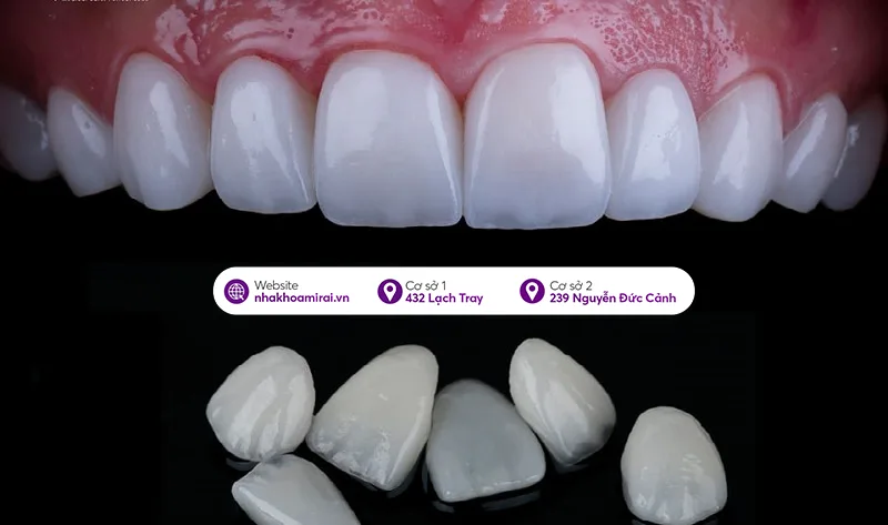 Răng Veneer - Chất liệu sứ thủy tinh siêu mỏng