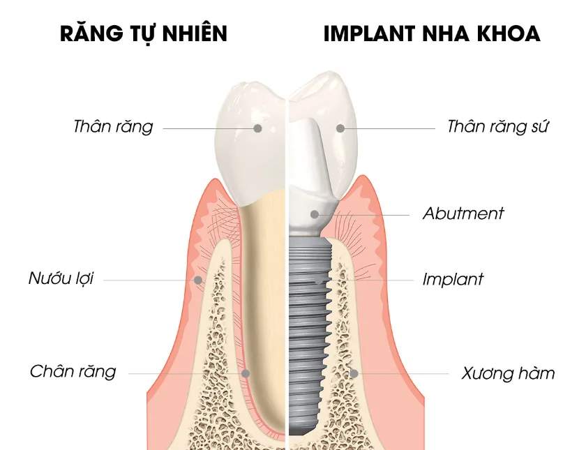 Cấu tạo của răng Implant và răng thật