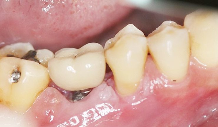 Phần lợi xung quanh Implant chưa lành hoặc tụt lợi gây dắt thức ăn
