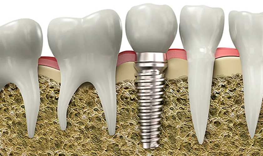 Sau trồng răng Implant sát khít với răng thật