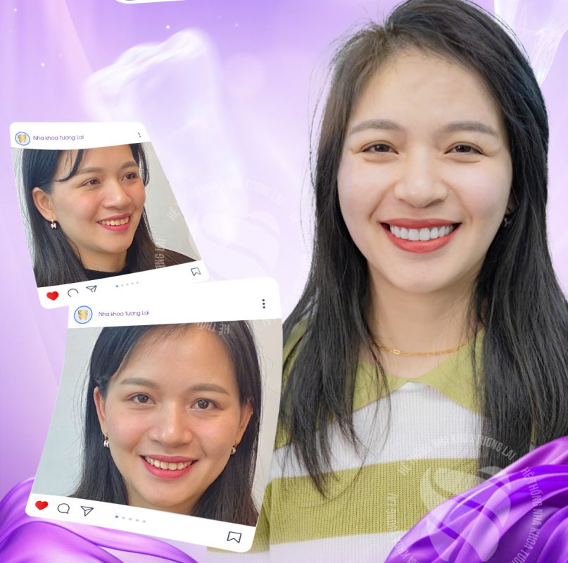 Bọc răng sứ thẩm mĩ