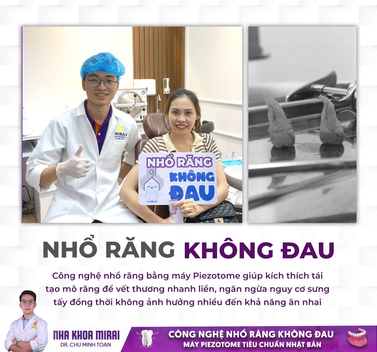 Nhổ răng khôn bằng máy Piezotome hạn chế sang chấn 