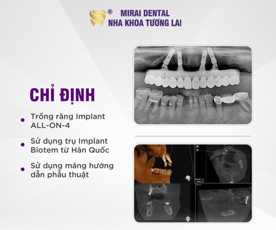 Trồng Implant Mất Bao Lâu?