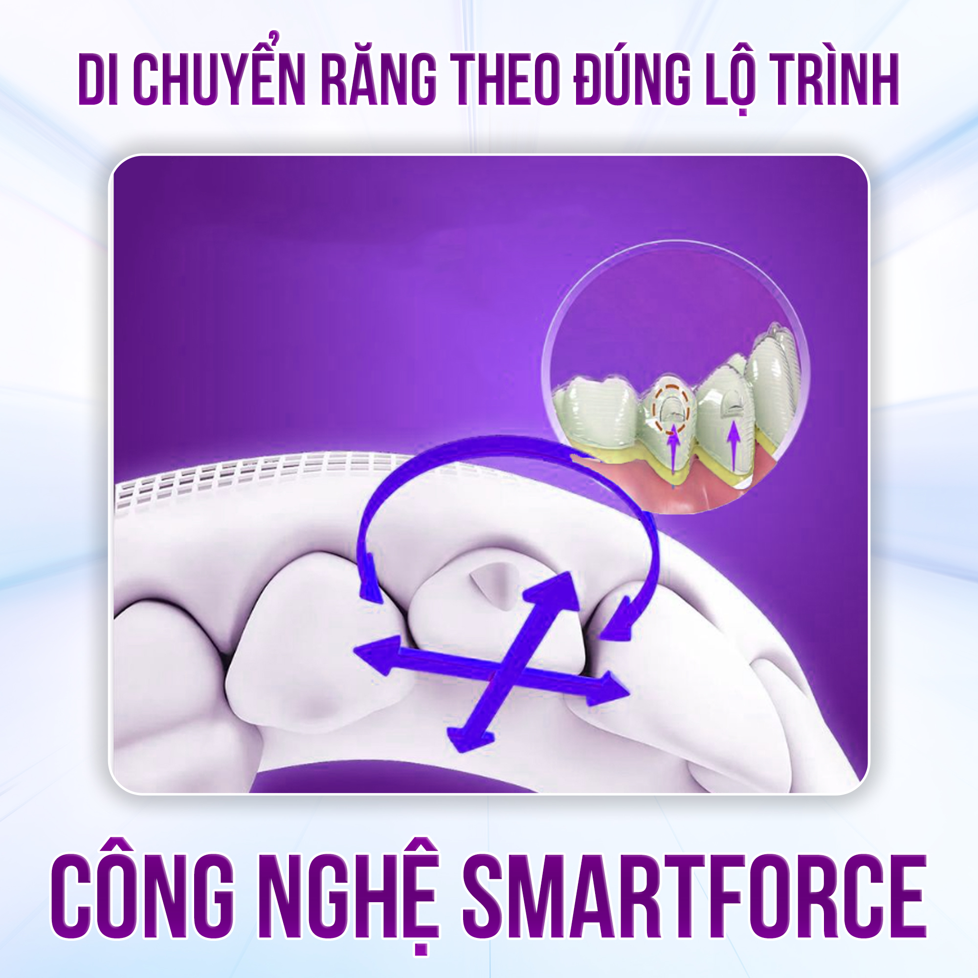 Công nghệ SmartForce Invisalign Công nghệ SmartForce Invisalign