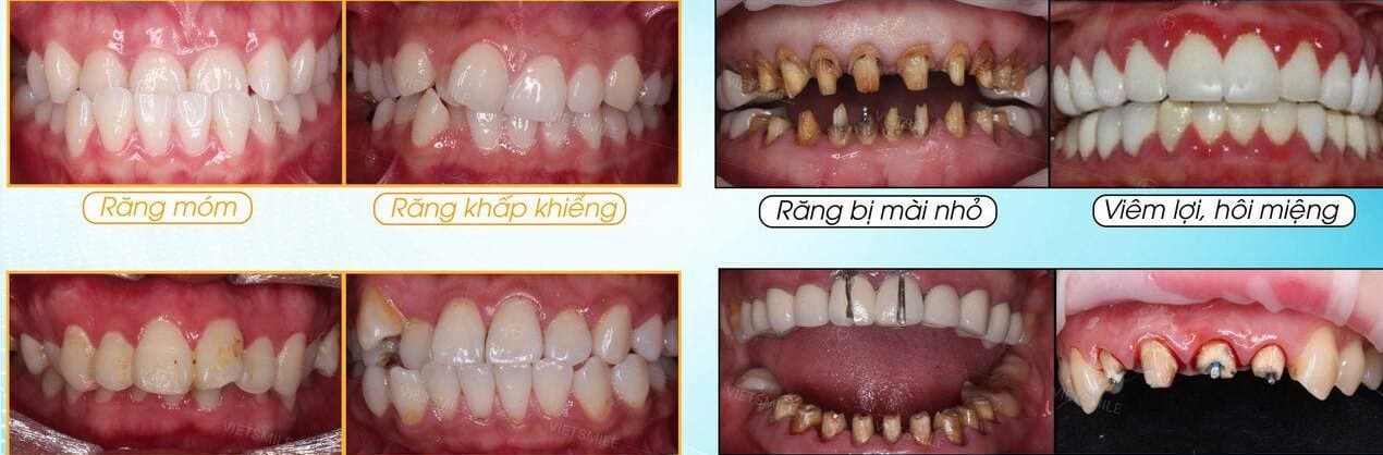 Bọc răng sứ có hại gì không? Ảnh hưởng khi sai chỉ định Bọc răng sứ có hại gì không? Ảnh hưởng khi sai chỉ định