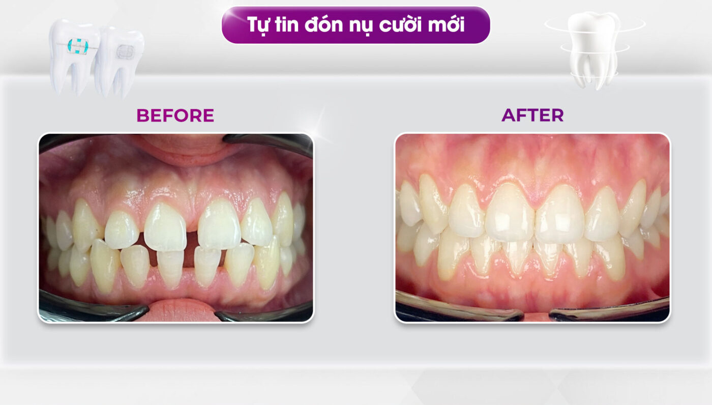 Niềng Răng Thưa Có Cần Nhổ Răng Không? 