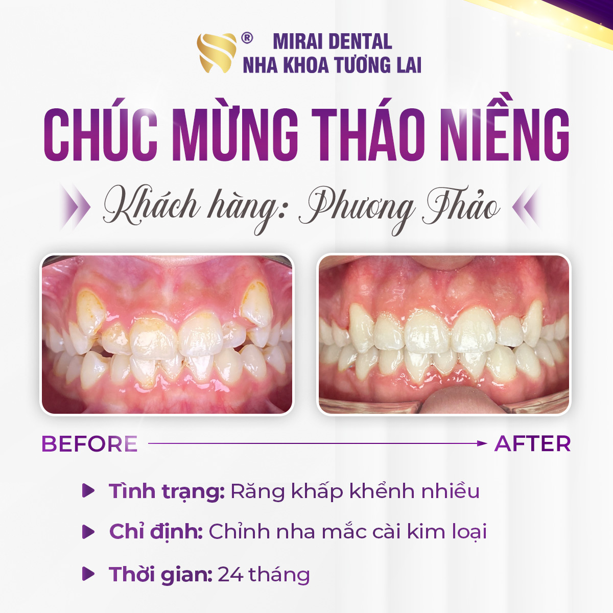 Niềng răng có đau không? Niềng răng có đau không?