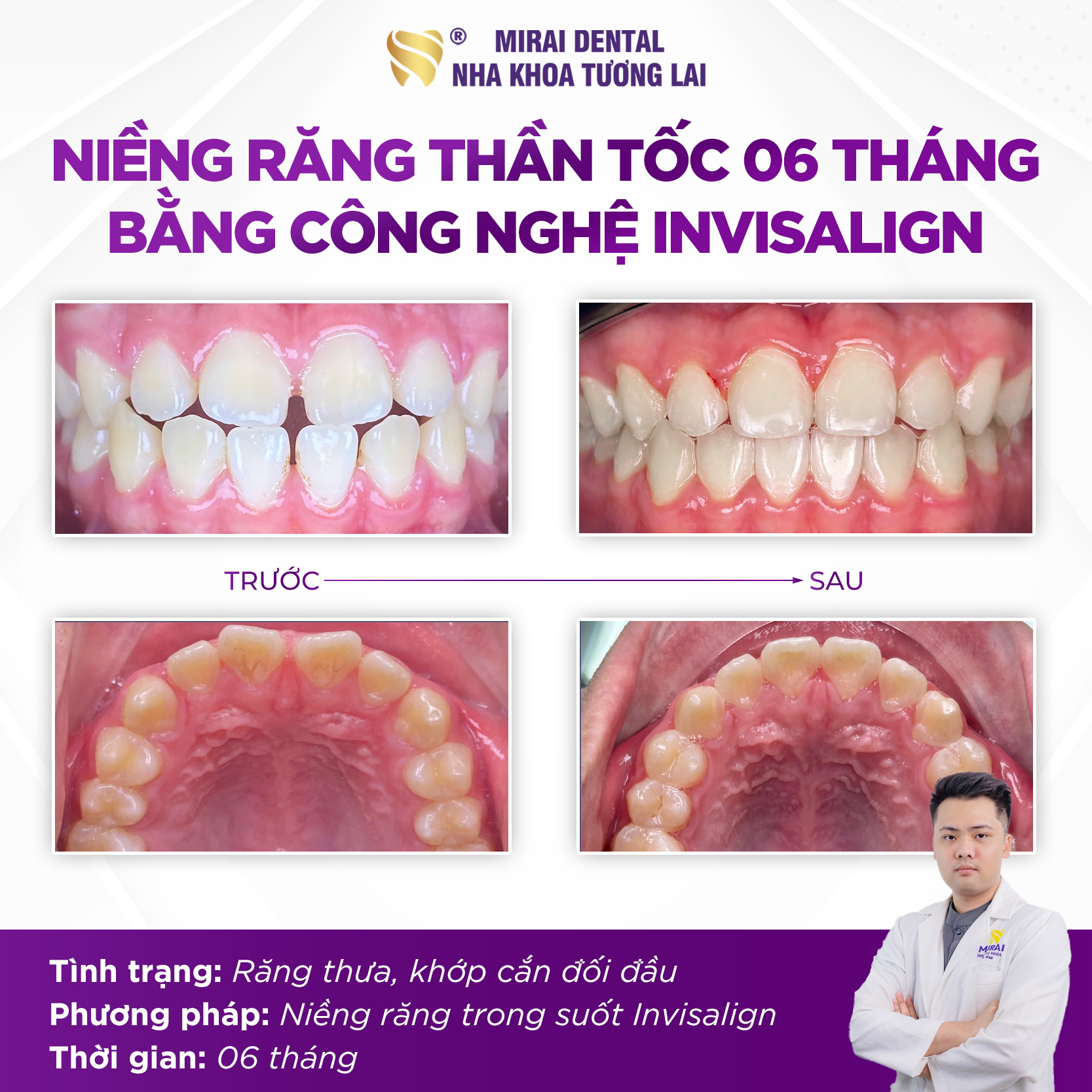 Niềng răng trong suốt Invisalign