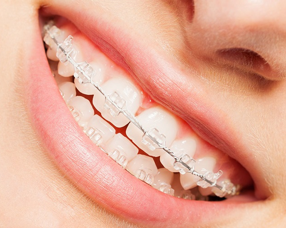 Các trường hợp bắt buộc phải niềng răng