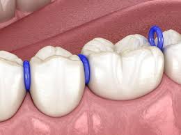 Đặt chun tách kẽ Đặt chun tách kẽ