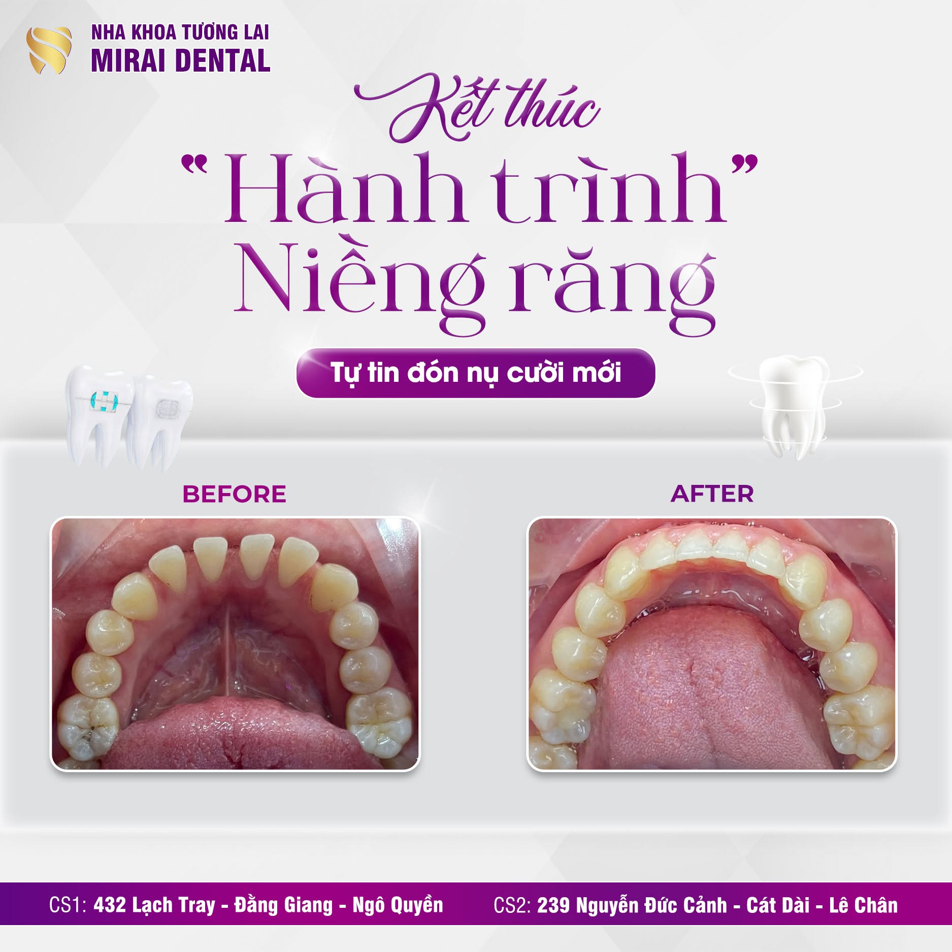 KH chỉnh răng thưa, đủ khoảng KH chỉnh răng thưa, đủ khoảng
