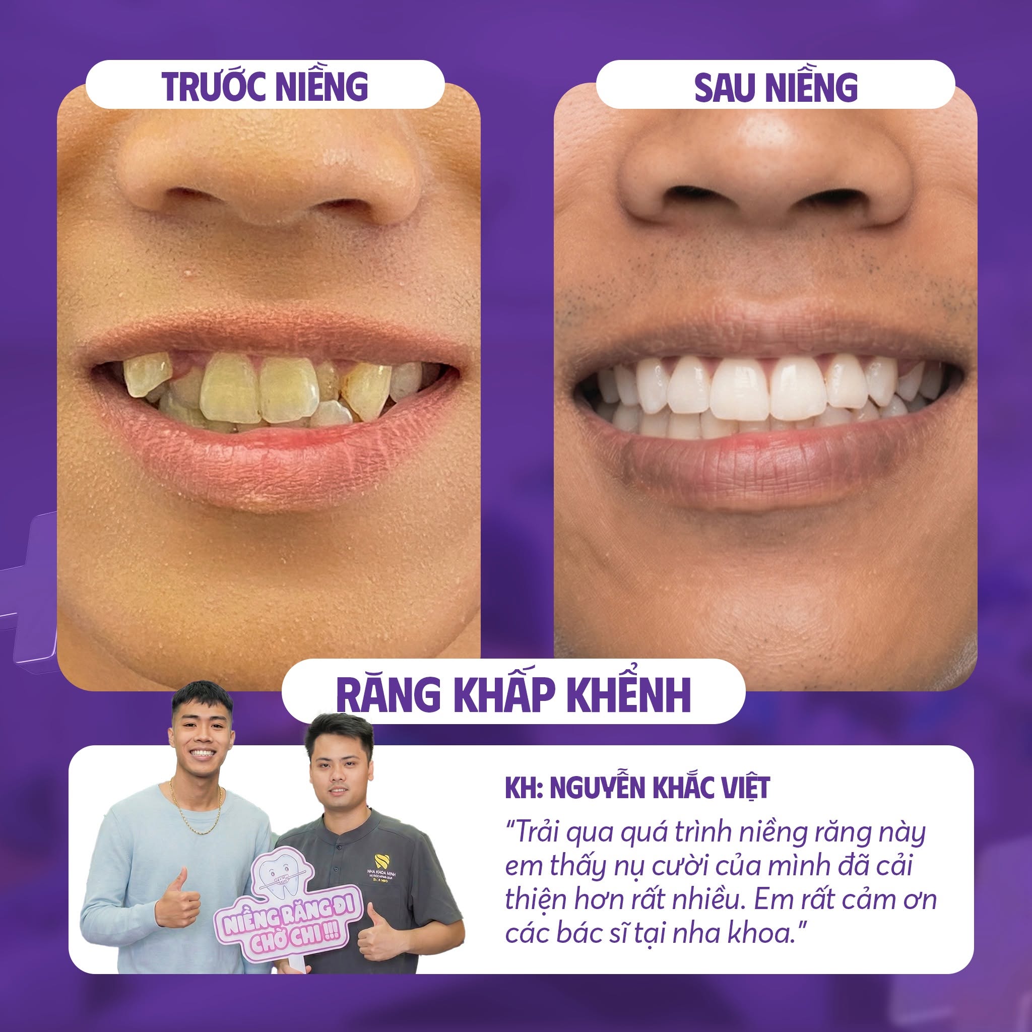 Niềng răng có phải nhổ răng không? Niềng răng có phải nhổ răng không?