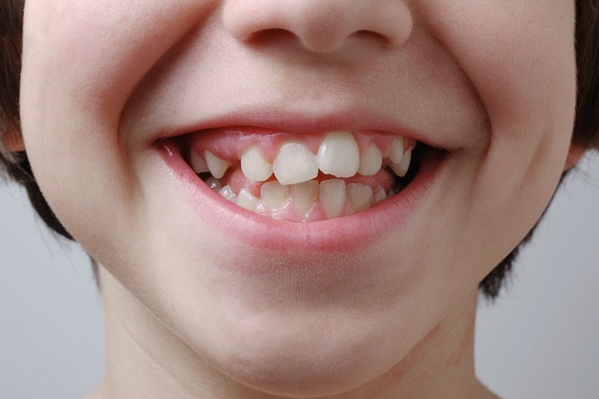 Răng cửa bị chìa ra trước do thói quen mút tay Răng cửa bị chìa ra trước do thói quen mút tay