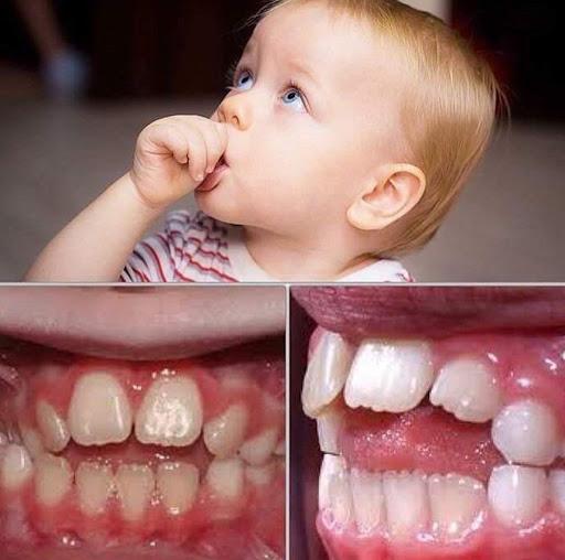 Mút tay ảnh hưởng đến sự phát triển của răng và xương hàm Mút tay ảnh hưởng đến sự phát triển của răng và xương hàm